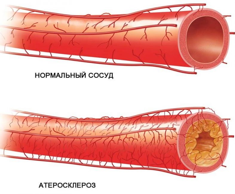 aterosclerosis